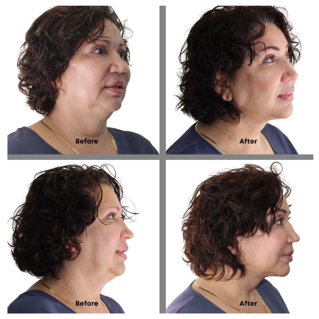 Instant Face Lift