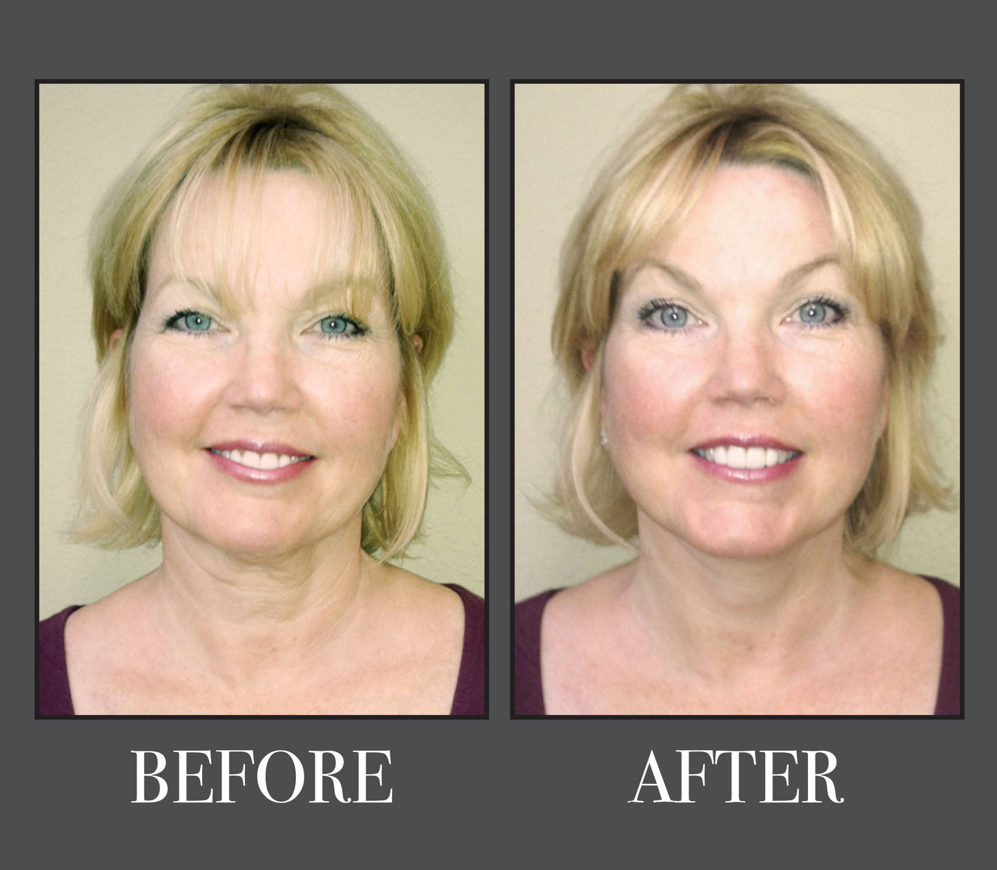 Instant Brow Lift