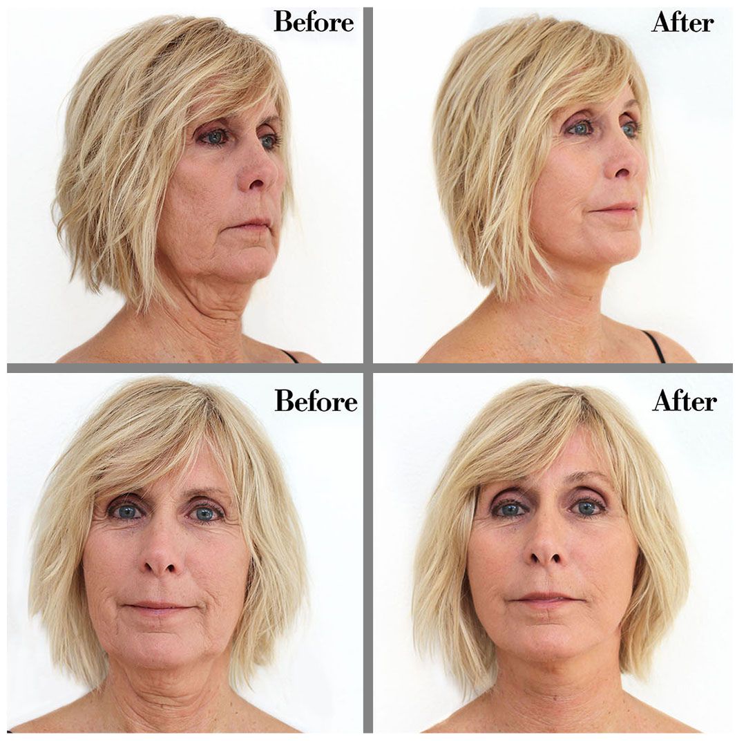 Instant Face Lift
