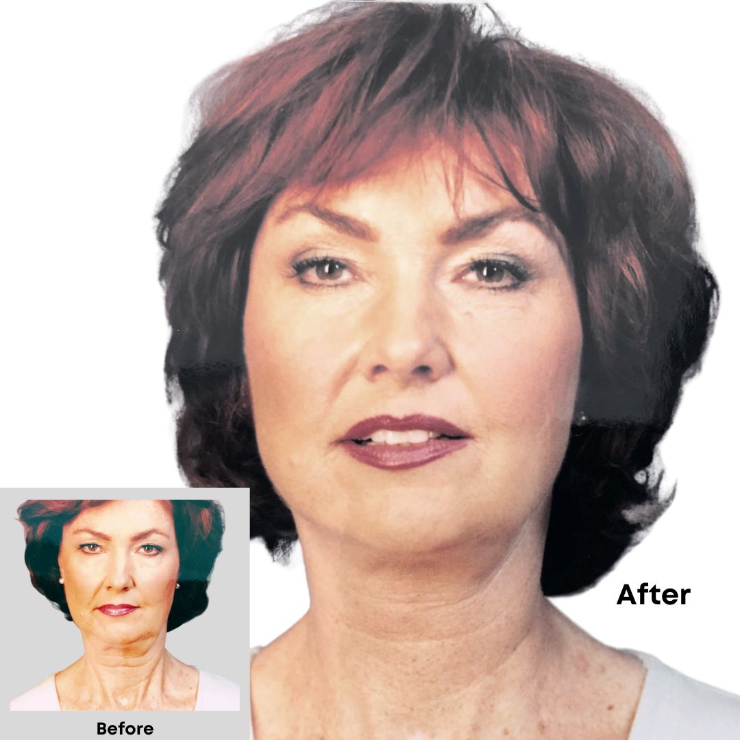 Instant Face Lift