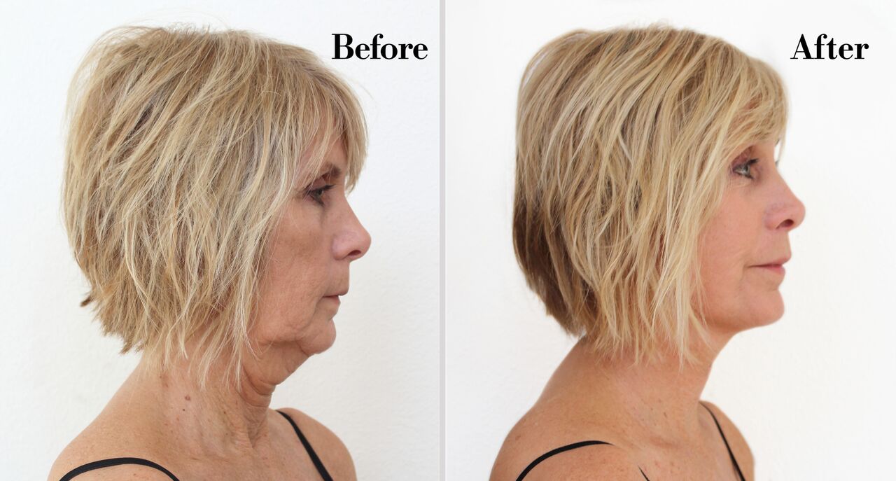 Non-Surgical Neck Lift Tape – Look Years Younger Instantly