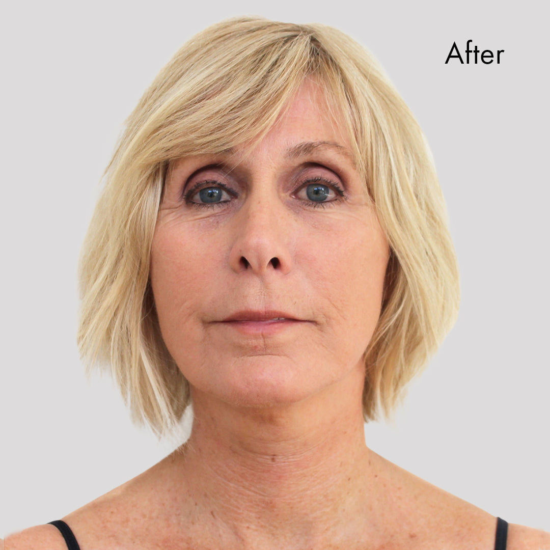 Instant Facelift Before and after  Instant face lift, Face lift tape,  Facelift