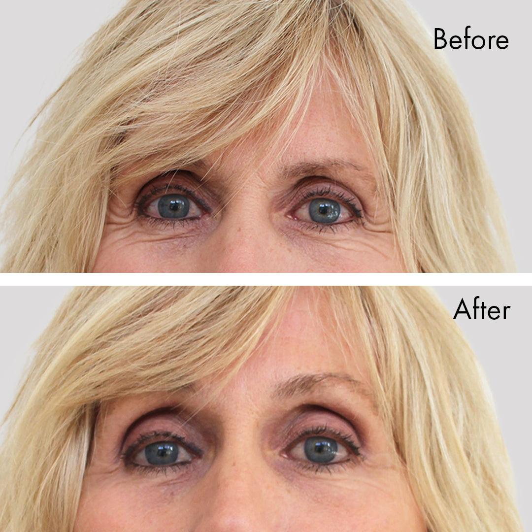 Instant Brow Lift