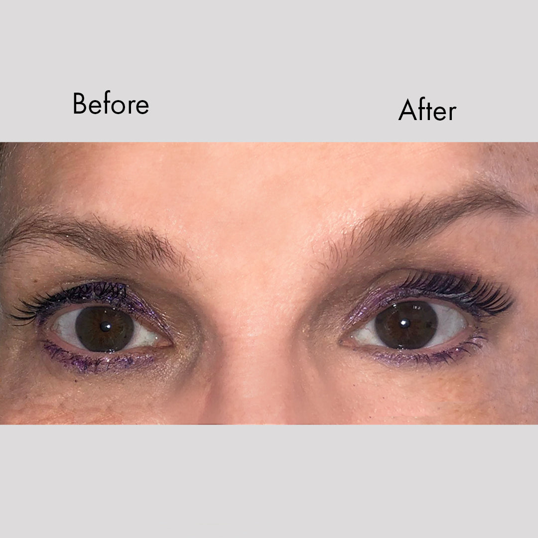 Instant Brow Lift