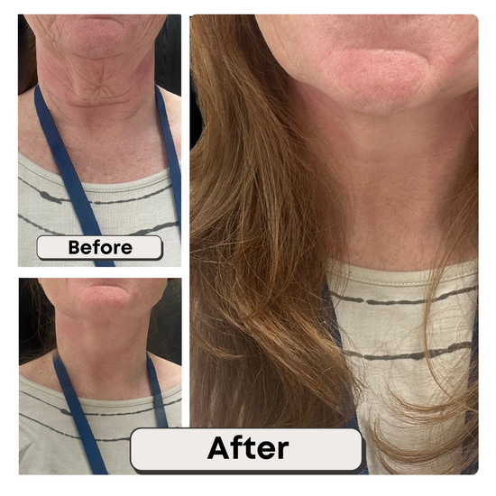 neck lift tape before and after