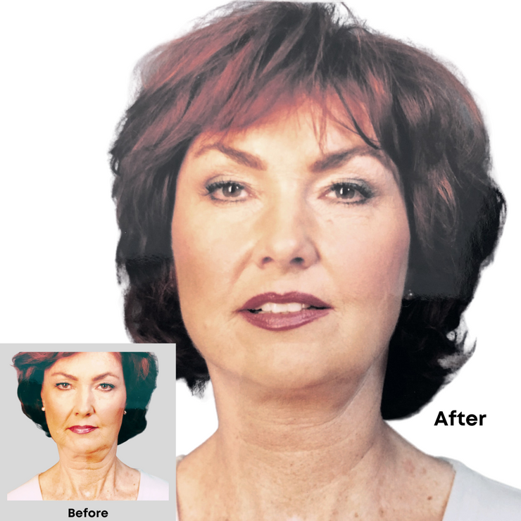 Before and After of women using Instant Neck Lift