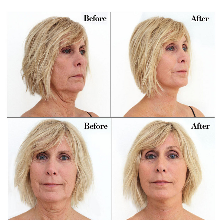 Before and After of woman using Instant Neck Lift