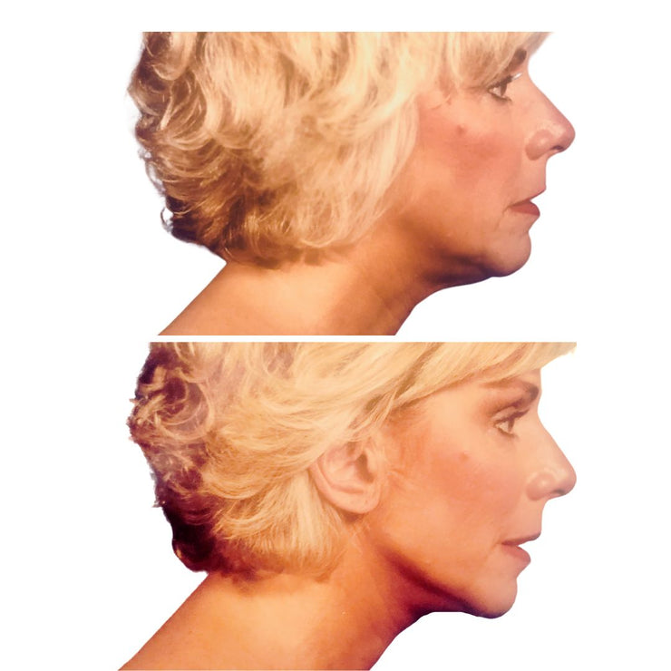 Before and after of chin with use of instant face lift.